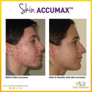 Skin Accumax 180 Capsules - Advanced Nutrition - Totally Refreshed Steam and Spa